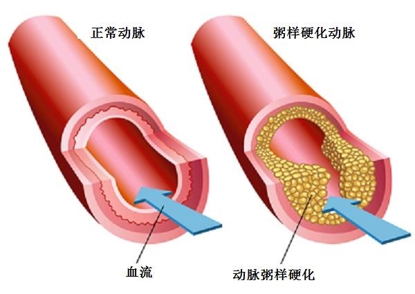 動(dòng)脈硬化大百科：動(dòng)脈粥樣硬化的發(fā)生機(jī)制